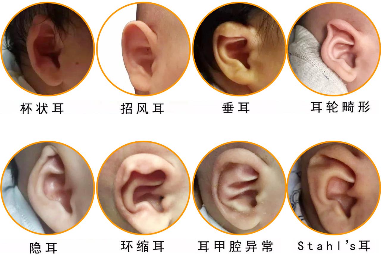 耳朵上有这条折痕，是心梗、猝死的“标志”？听听专家怎么说_耳垂