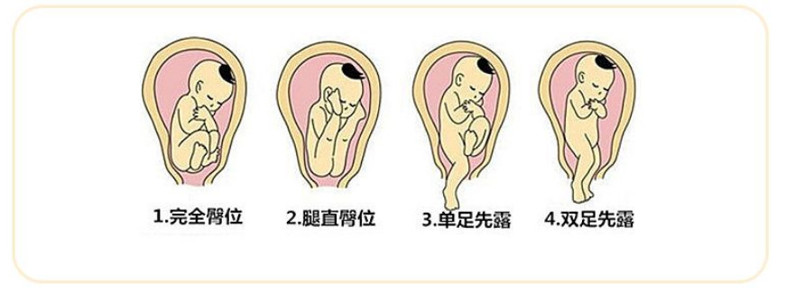 no!她两次臀位都成功顺产.